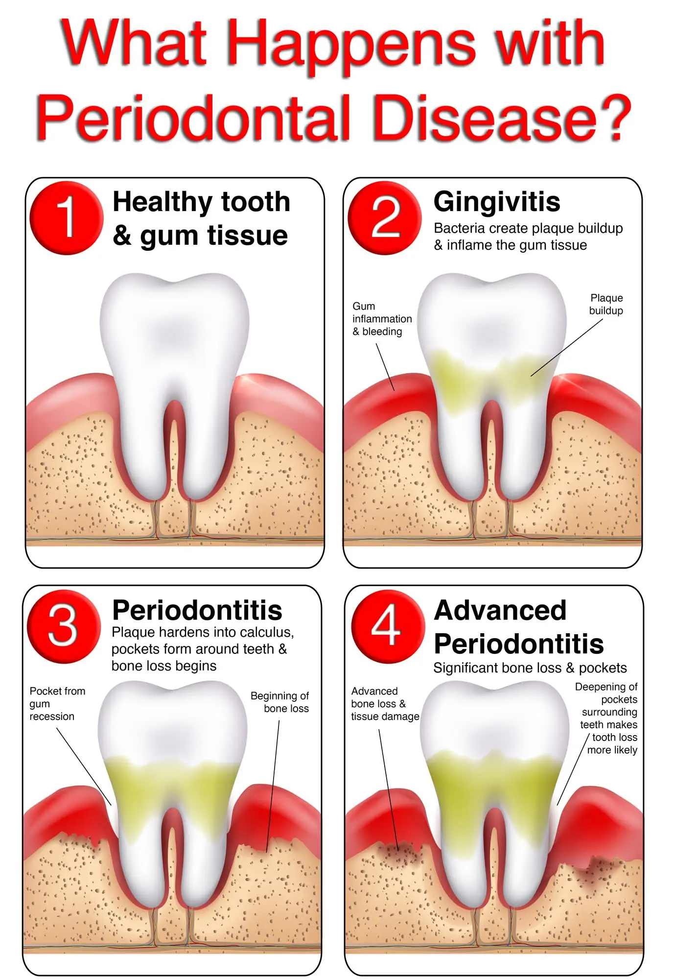 Periodontitis &#8211; causes, symptoms, treatment [WE EXPLAIN]