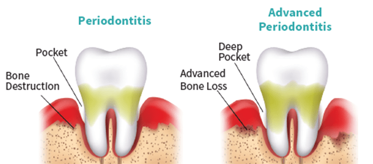 Periodontology &#8211; what is it and what does it do? What diseases does the periodontologist treat?