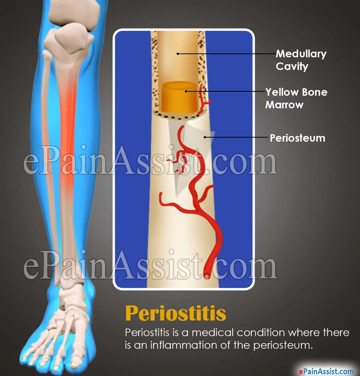 Periostitis &#8211; causes, symptoms, treatment