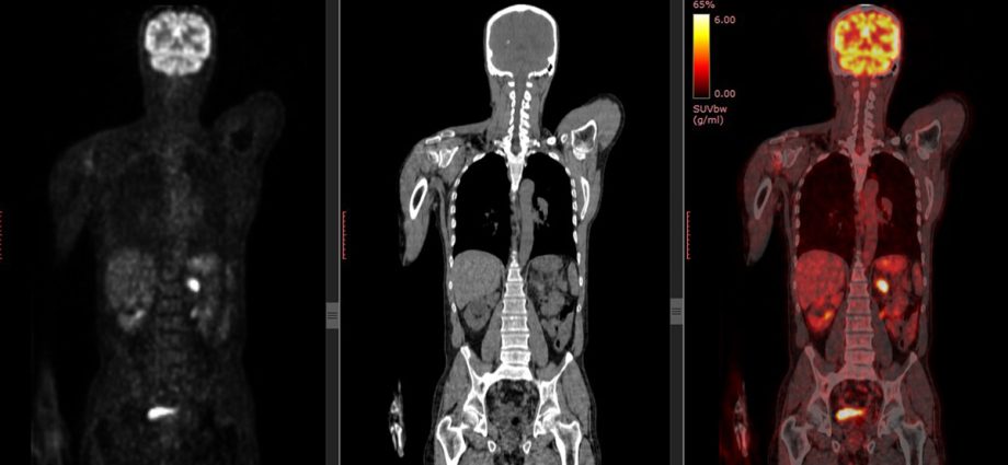 PET-CT examination