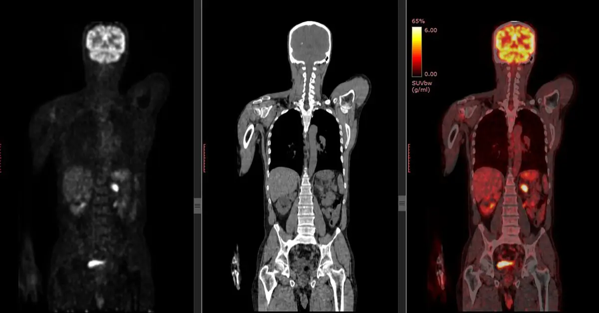 PET-CT examination