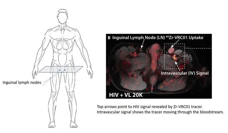 PET scanning can reveal crouching HIV