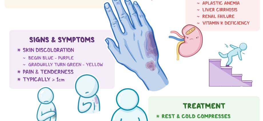 Petechiae &#8211; why do they appear on the body? Diagnosis and treatment of ecchymosis