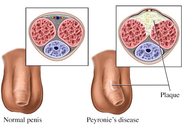 Peyronie&#8217;s disease &#8211; symptoms, diagnosis, treatment, prognosis