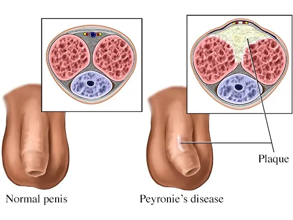 Peyronie&#8217;s disease &#8211; symptoms, diagnosis, treatment, prognosis