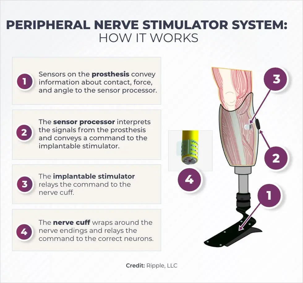 Phantom pain &#8211; what is it, causes, how to combat it?