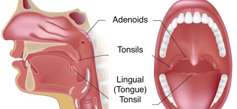 Pharyngeal tonsil &#8211; what are the symptoms of hypertrophy and what is the surgical treatment?