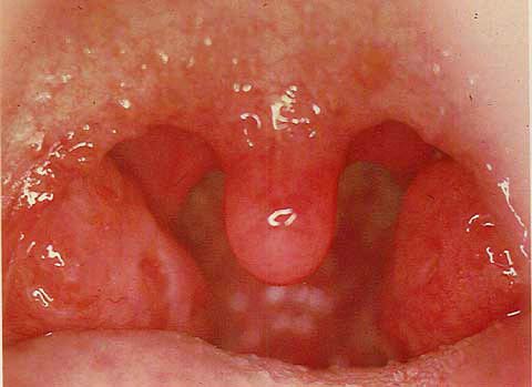 Pharyngitis, or angina