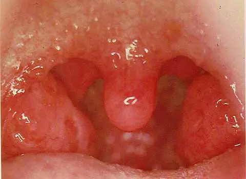 Pharyngitis, or angina