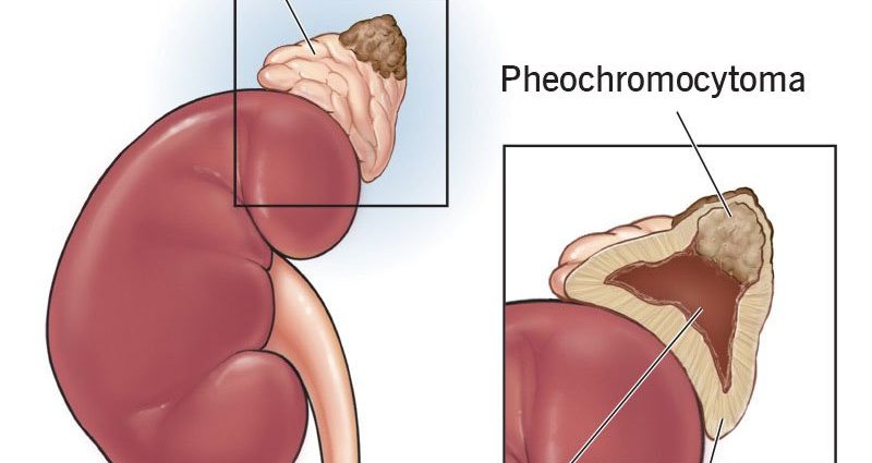 Pheochromocytoma Symptoms Causes Prognosis Healthy Food Near Me 4836