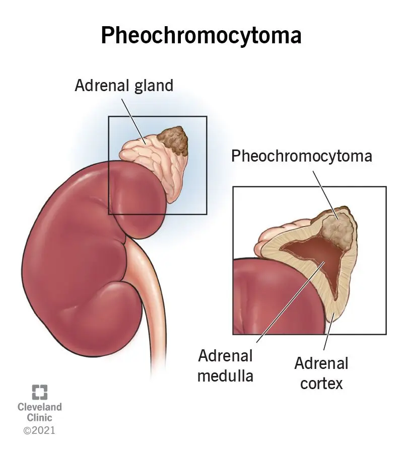 Pheochromocytoma &#8211; symptoms, causes, prognosis