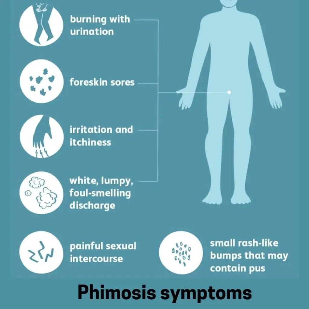 Phimosis &#8211; Symptoms and Treatment