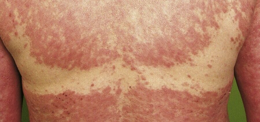 Photoallergic eczema &#8211; causes, symptoms and treatment