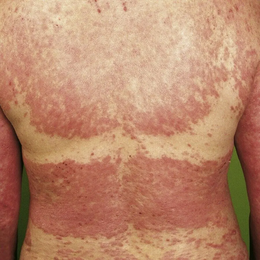 Photoallergic eczema &#8211; causes, symptoms and treatment