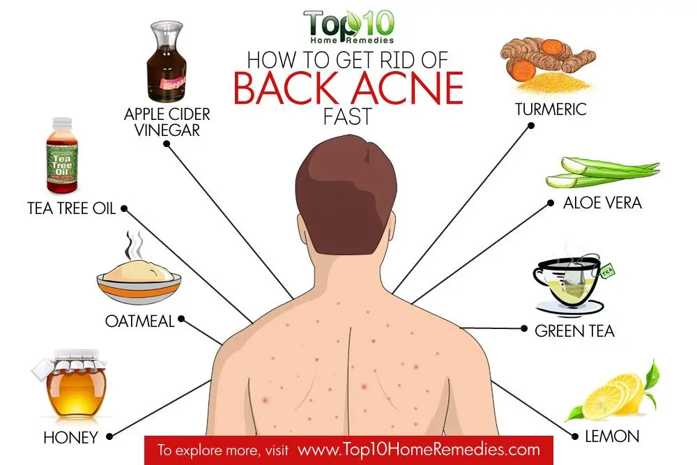 Pimples on the back &#8211; causes, treatment, home remedies