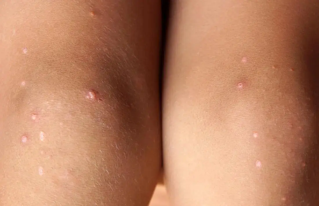 Pimples on the legs &#8211; causes, treatment