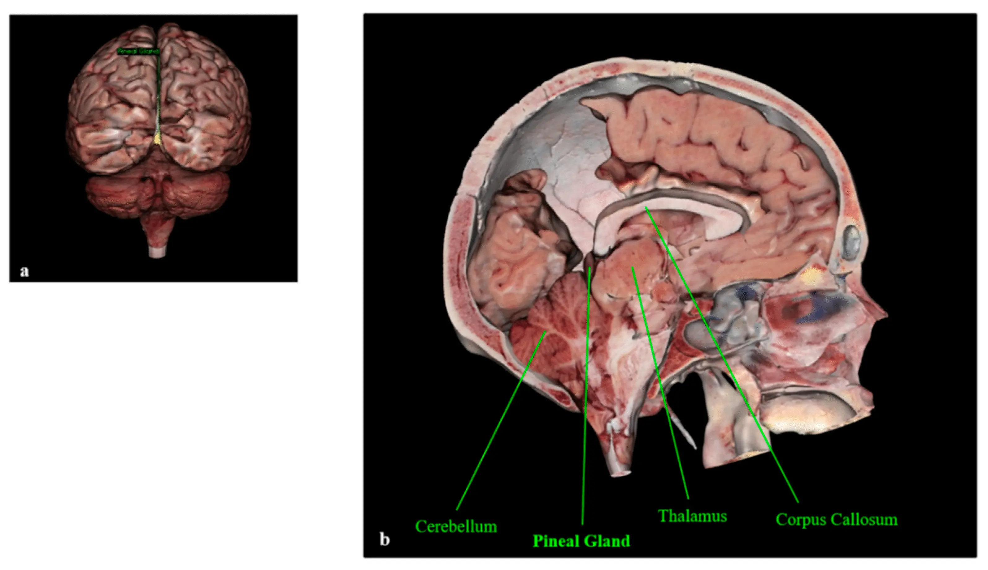 Pineal gland &#8211; location, pineal tumor, prophylaxis [EXPLAINED]