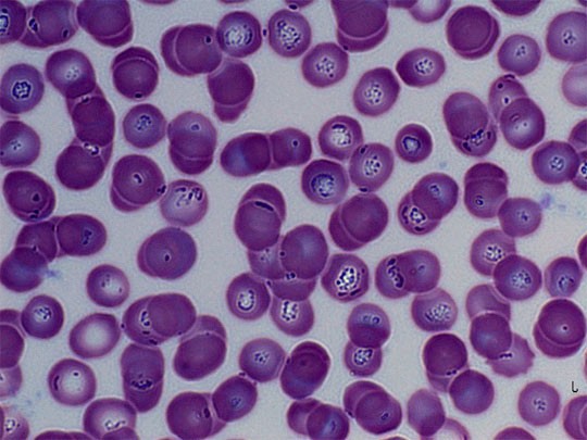 Piroplasmosis CRS