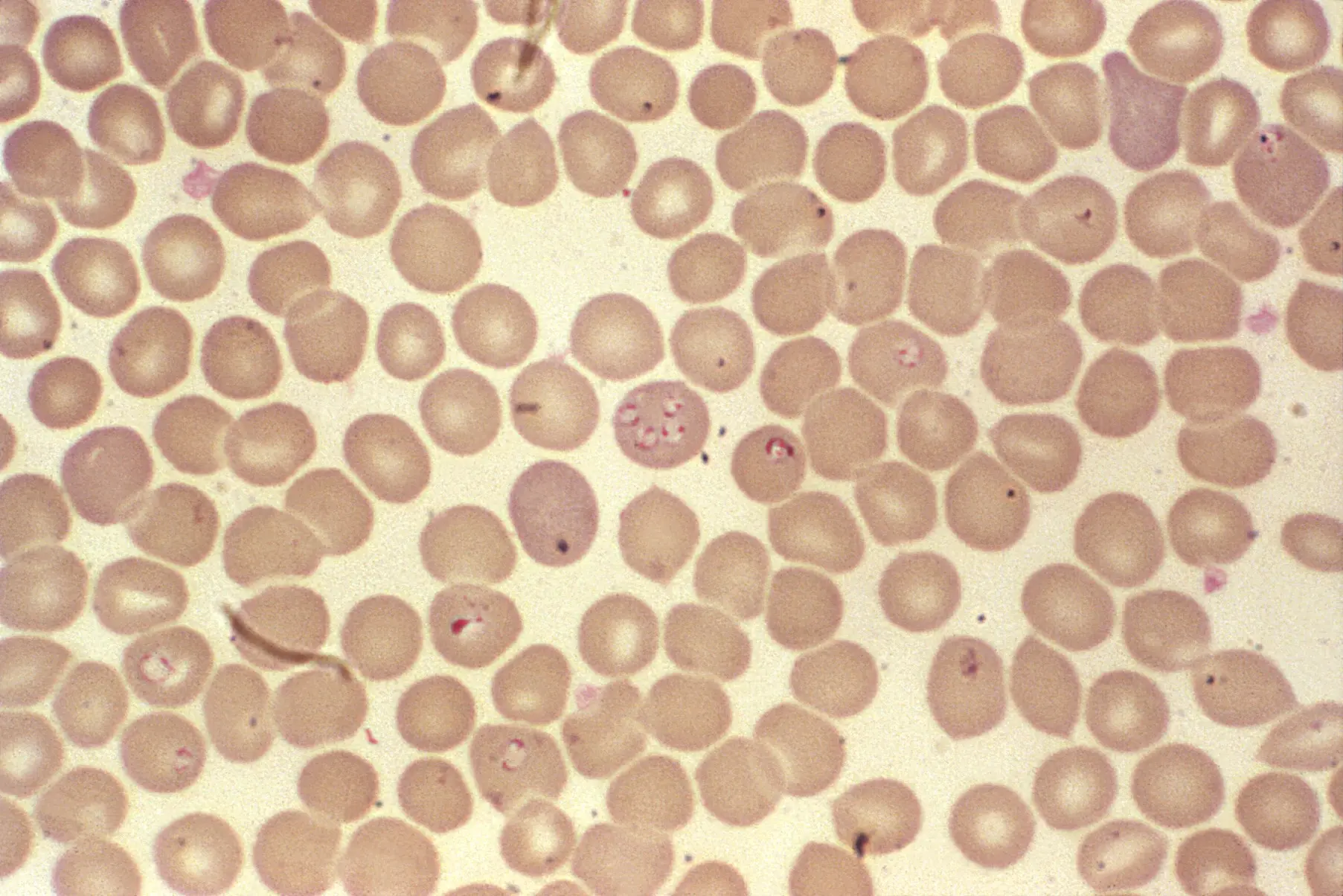 Piroplasmosis CRS