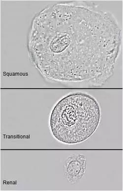 Plain epithelium in urine &#8211; what does it mean?