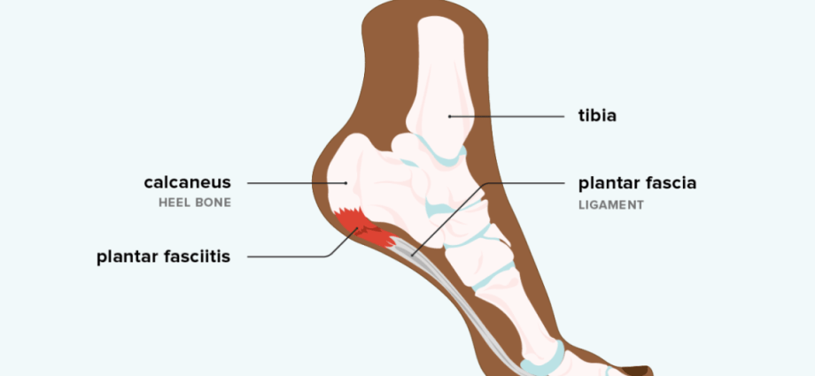 Plantar fasciitis &#8211; what is it, what causes it and how to treat it?