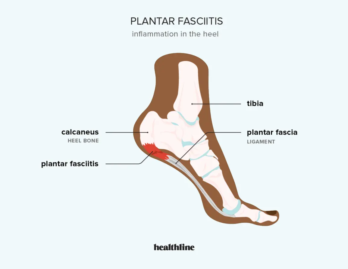 Plantar fasciitis &#8211; what is it, what causes it and how to treat it?