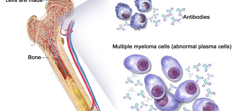 Plasma cell tumor isolated