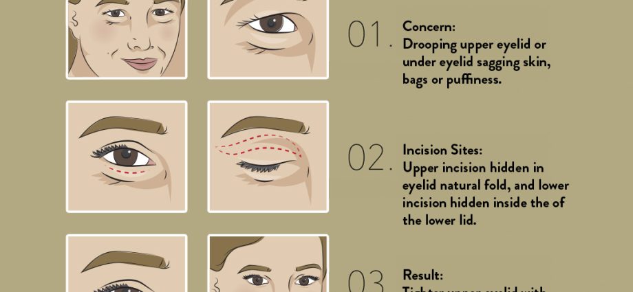 Plastic surgery of the eyelids &#8211; indications, contraindications and course. How much does blepharoplasty cost?