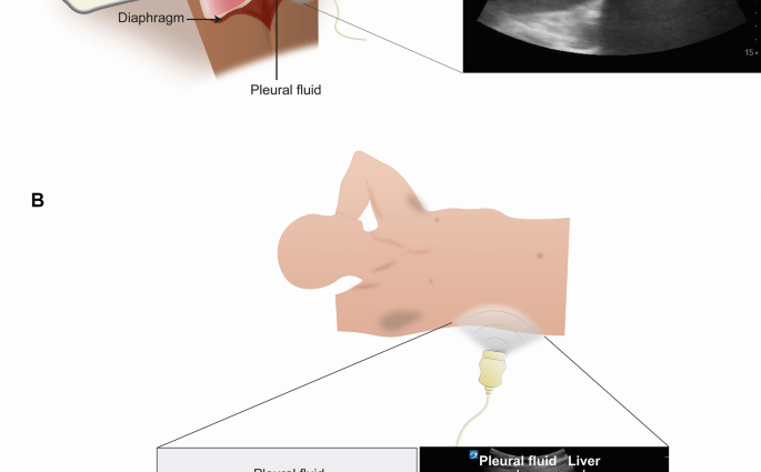 Pleural ultrasound &#8211; indications, preparation for examination, course