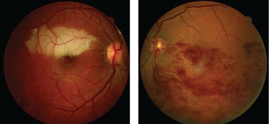 Poisoning and eye damage caused by drugs