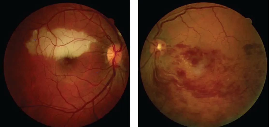 Poisoning and eye damage caused by drugs