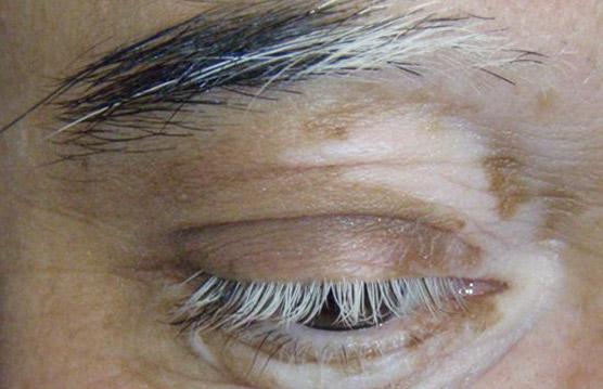 Poliosis &#8211; what is it, causes, treatment