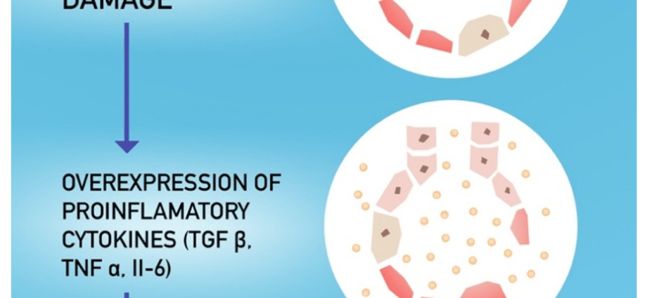 Polish scientists are checking whether spironolactone prevents lung fibrosis in COVID-19