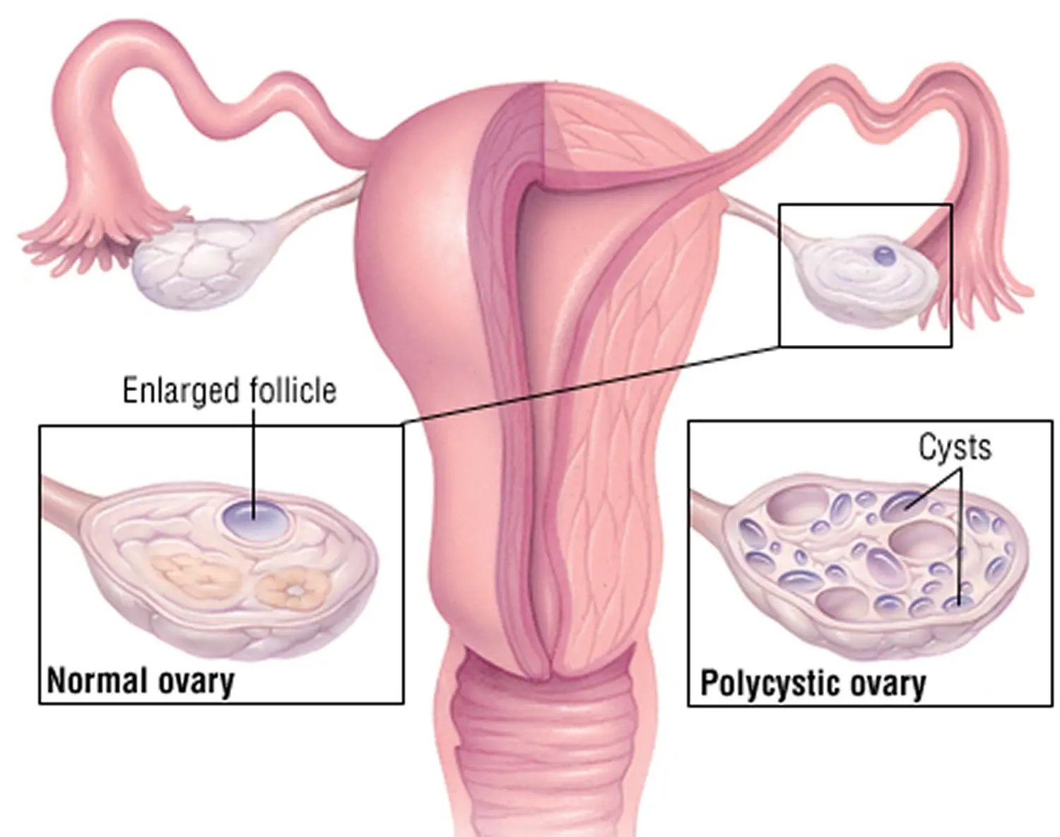 Polycystic ovaries &#8211; the mystery still unknown