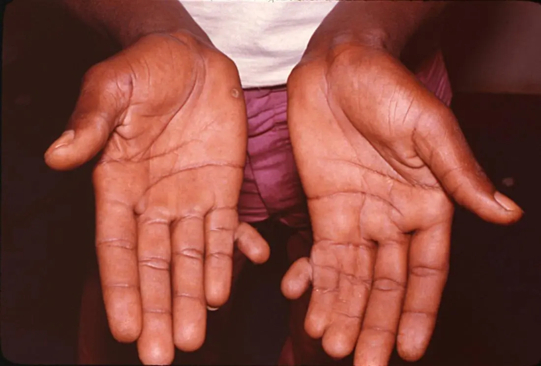 Polydactyly &#8211; Not everyone has only 10 fingers