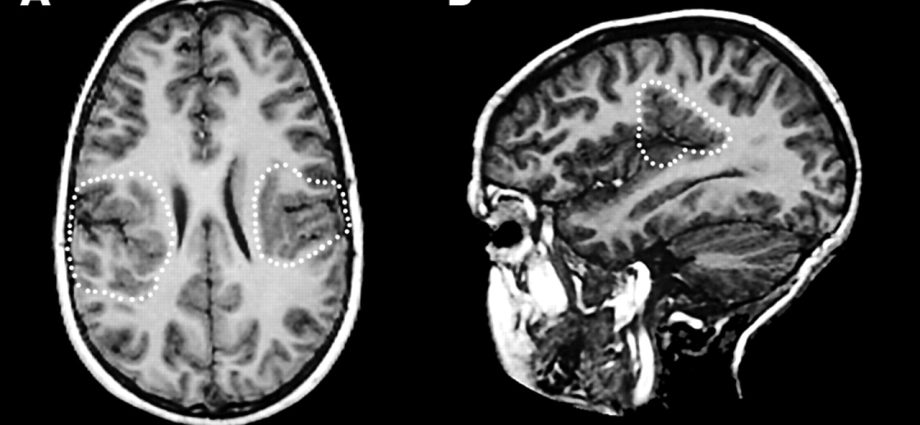 Polymicrogyria: frills in the brain