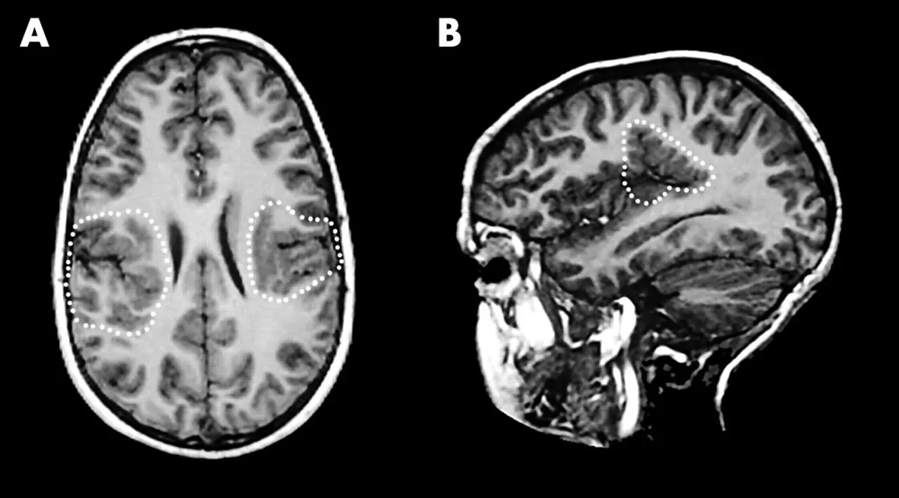 Polymicrogyria: frills in the brain