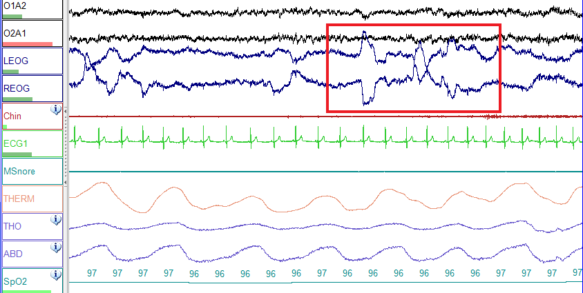 Polysomnography