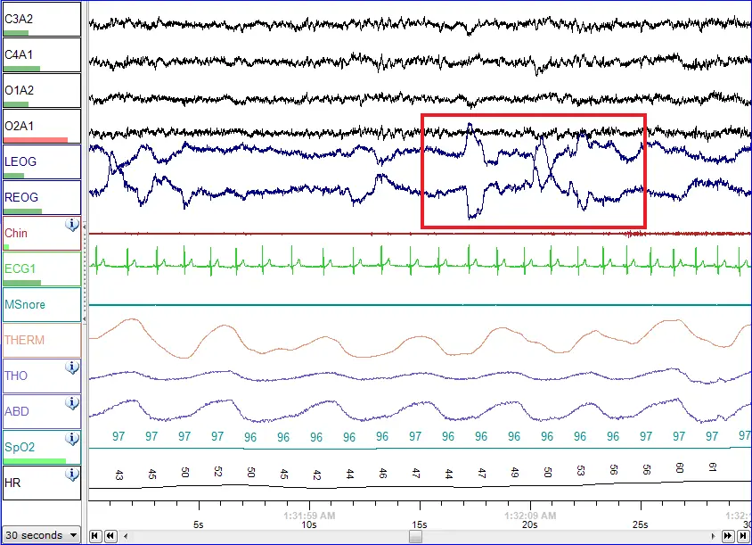 Polysomnography