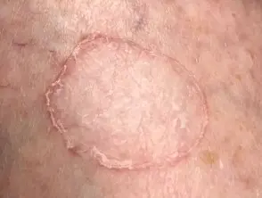 Porokeratosis