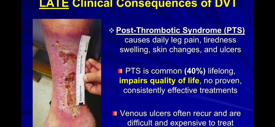 Post-thrombotic syndrome &#8211; symptoms, treatment, prevention