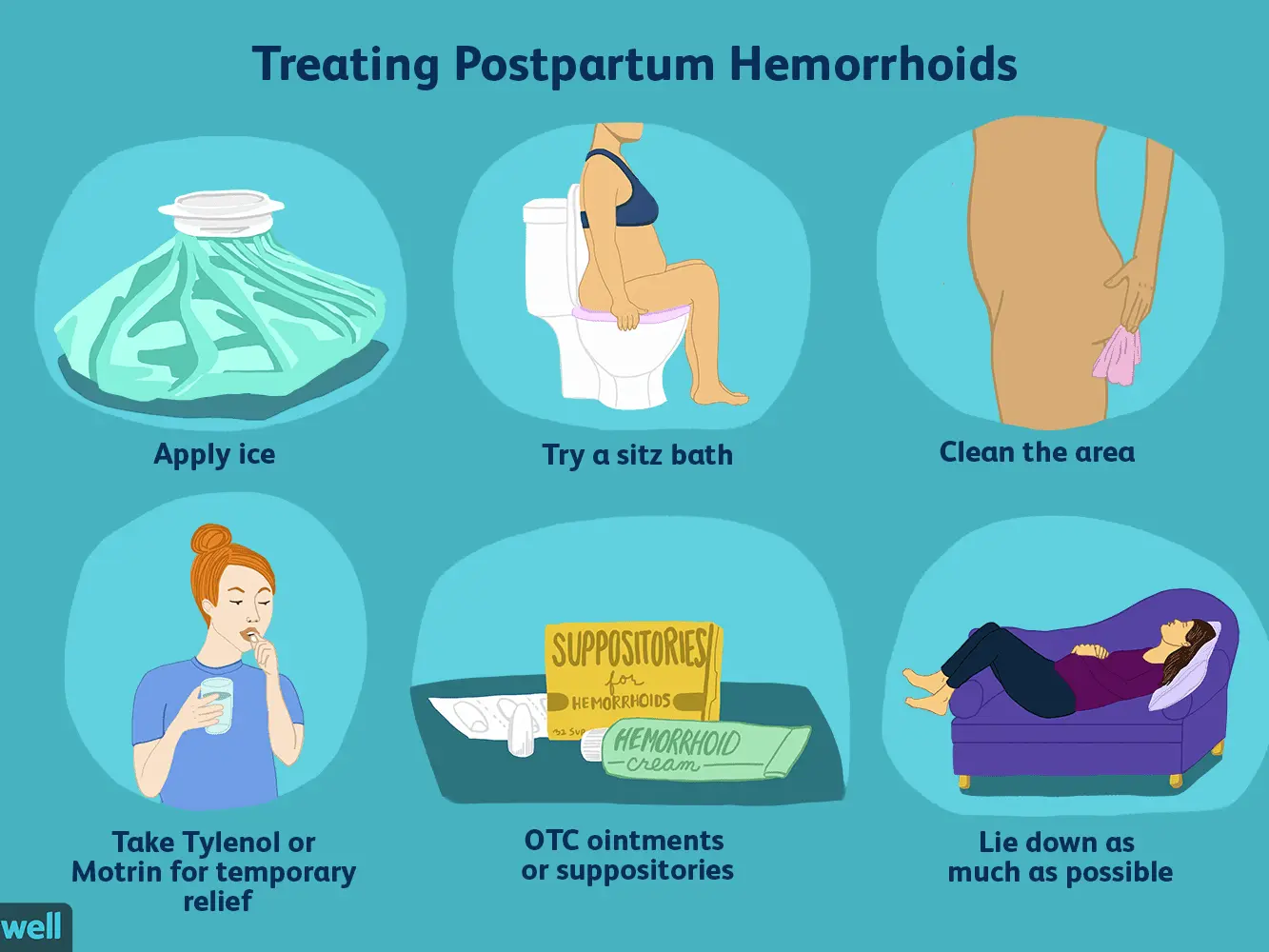 Postpartum hemorrhoids &#8211; what they are, symptoms, treatment