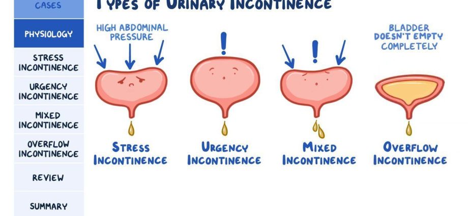 Pregnancy and NTM &#8211; when does urinary incontinence occur?