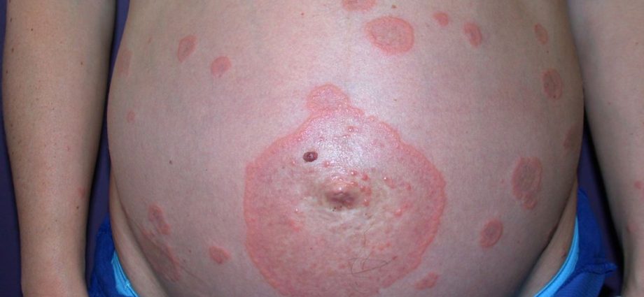 Pregnant pemphigoid &#8211; when does rash occur?