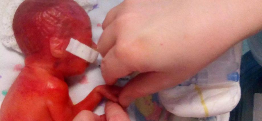 Premature babies &#8211; what do they look like? What are they exposed to?