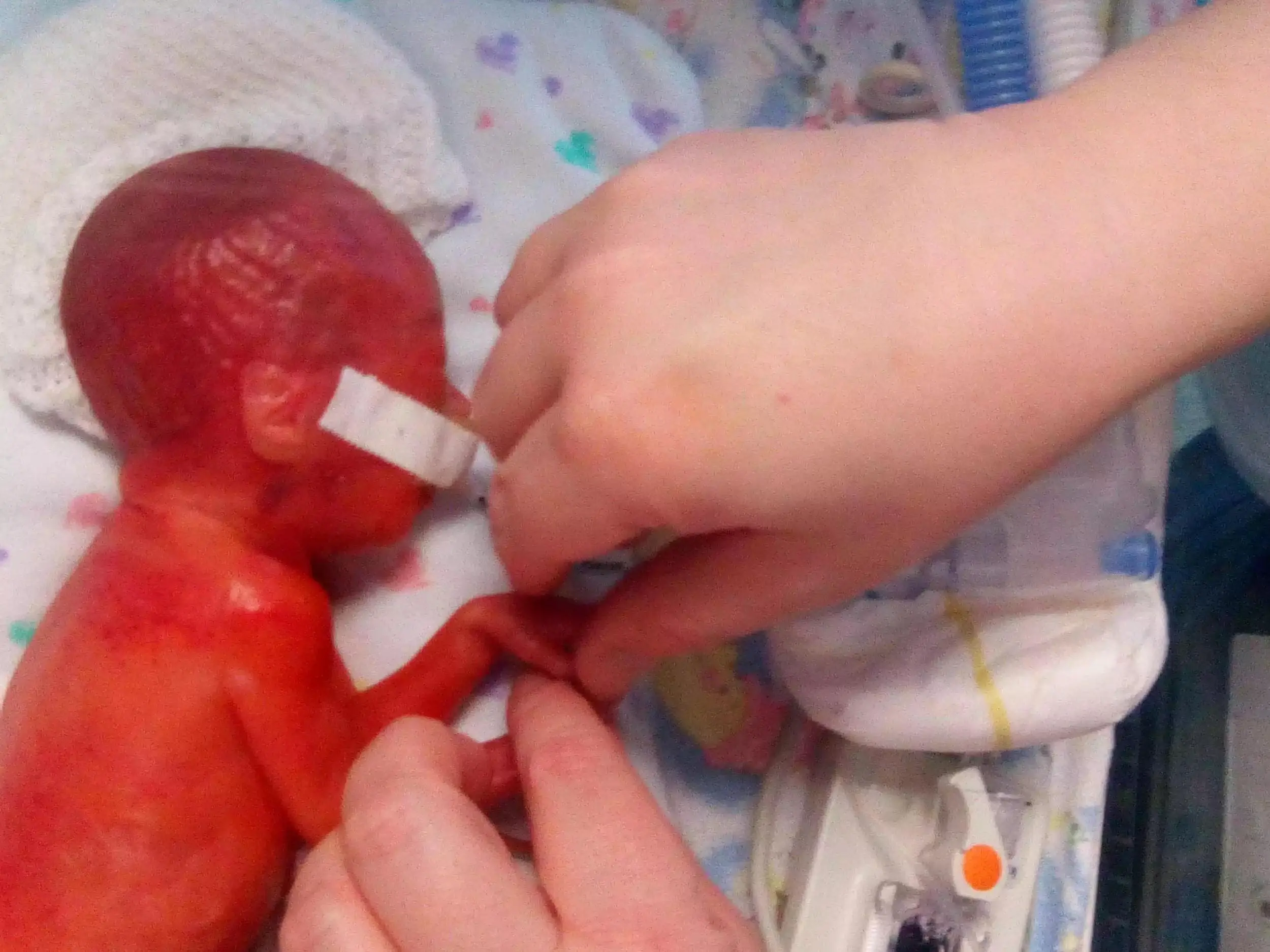 Premature babies &#8211; what do they look like? What are they exposed to?