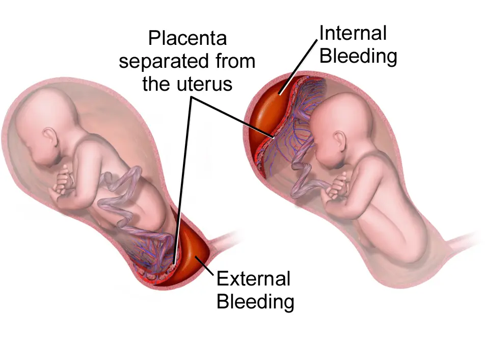 Premature detachment of the placenta