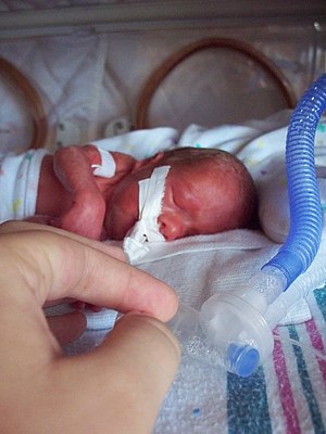 Prematurity is not a sentence