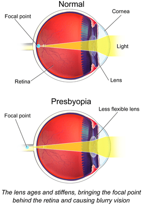 Presbyopia, which is what?