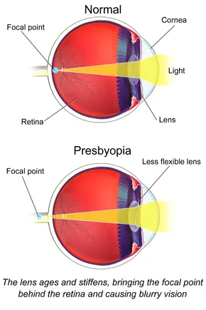 Presbyopia, which is what?